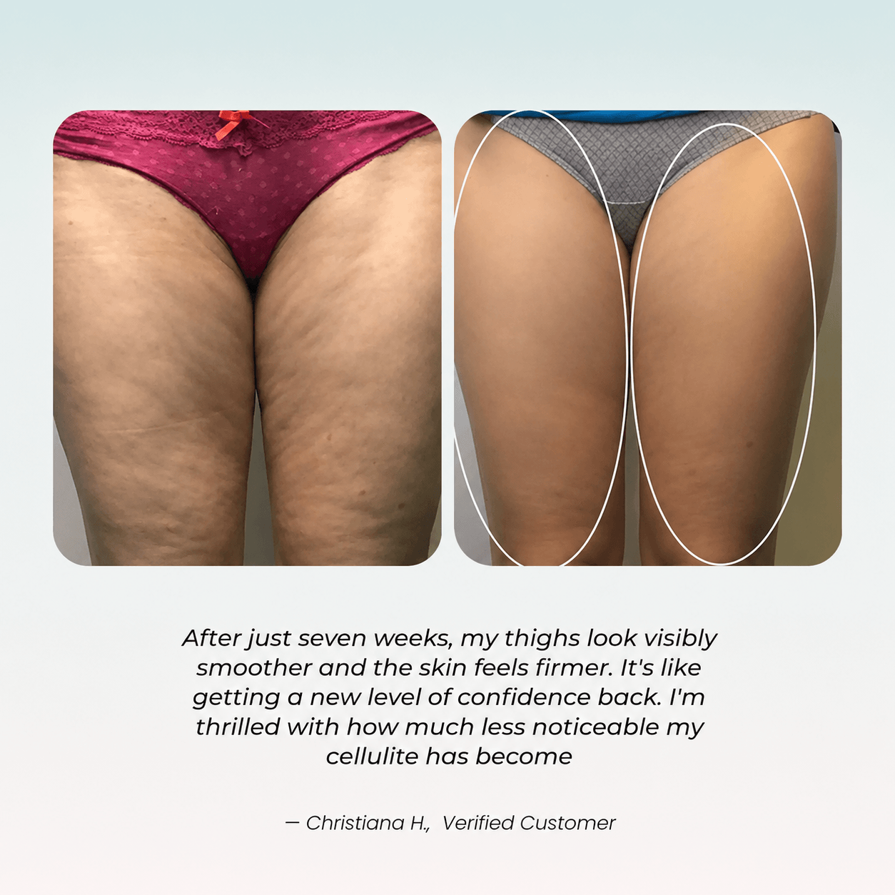 Glovea™ - EMS + Red Light Lymphatic Drainage Sculpting System