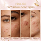 Glovea™ - Acne Buster